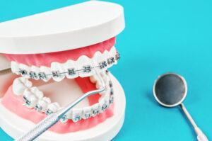 A close-up of metal traditional braces, highlighting the brackets and wires used for orthodontic treatment.