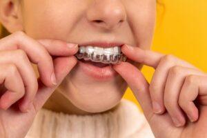 A girl placing her Invisalign aligner, showcasing the clear and discreet orthodontic treatment.