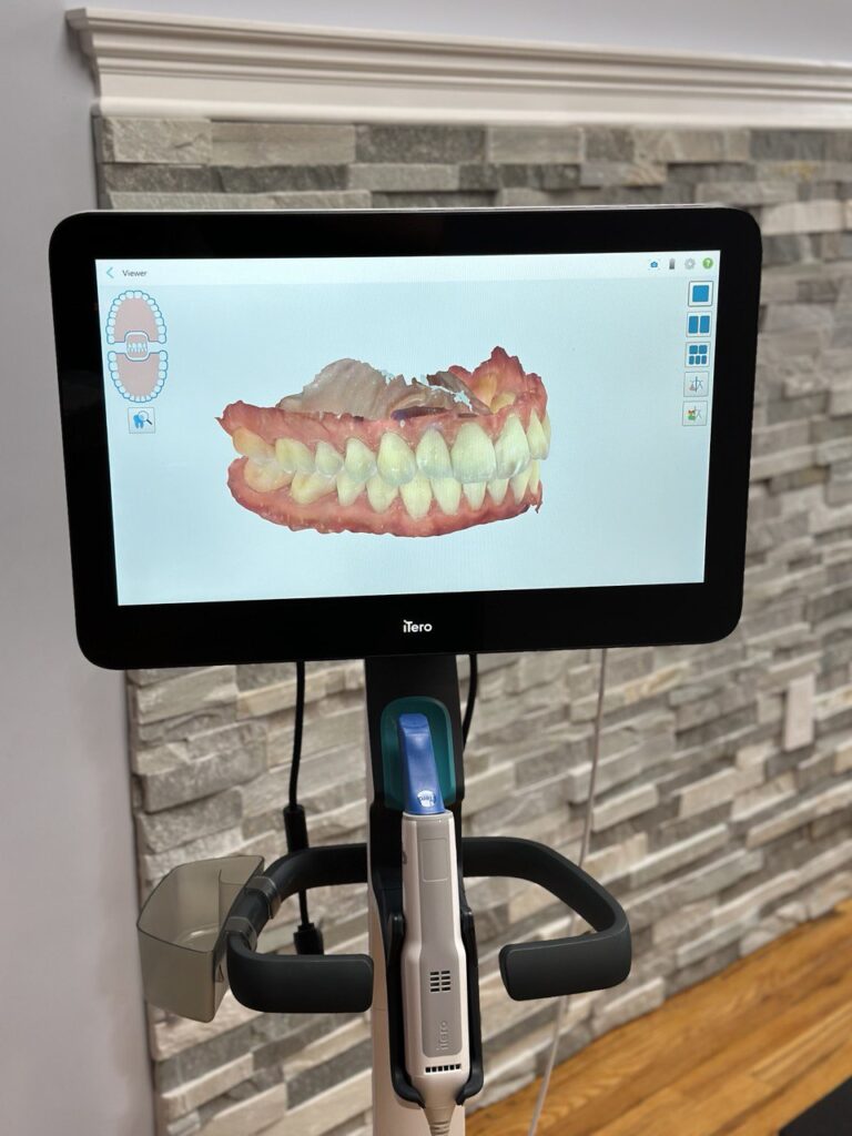 iTero Intraoral Scanner used for digital orthodontic impressions