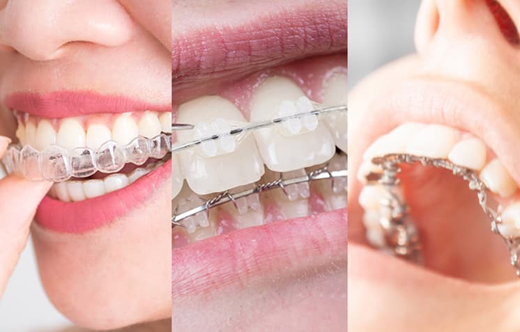 Metal & Ceramic and Personalized Invisalign Braces