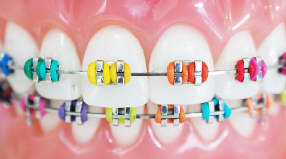 teeth braces color choosing colors look good