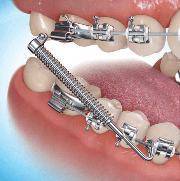 Braces with Metal Springs Adjustments and Expectations