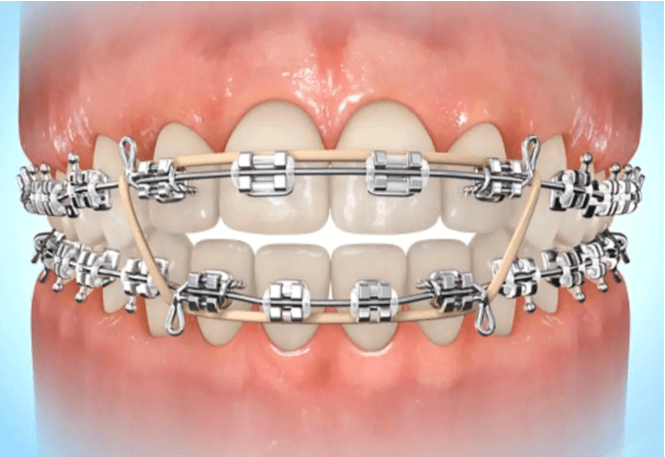Braces with elastic bands used for orthodontic treatment adjustments