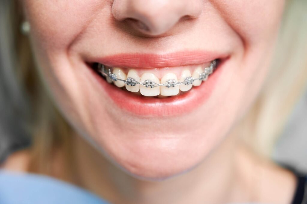 Braces Silver Bands