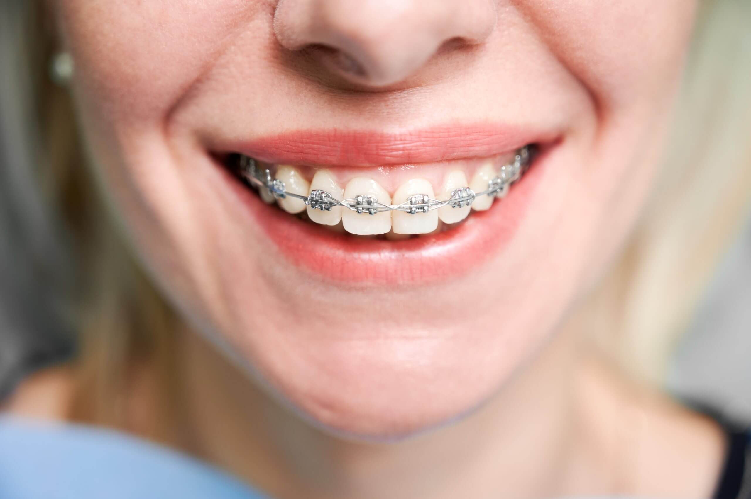 Silver Braces Silver Braces