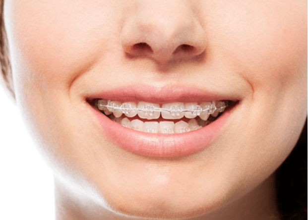 Ceramic Braces Silver Bands