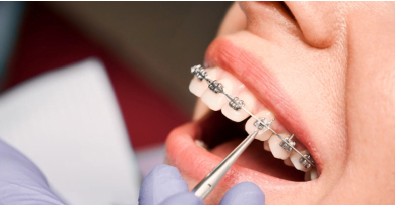 How orthodontists tighten braces during adjustment appointments