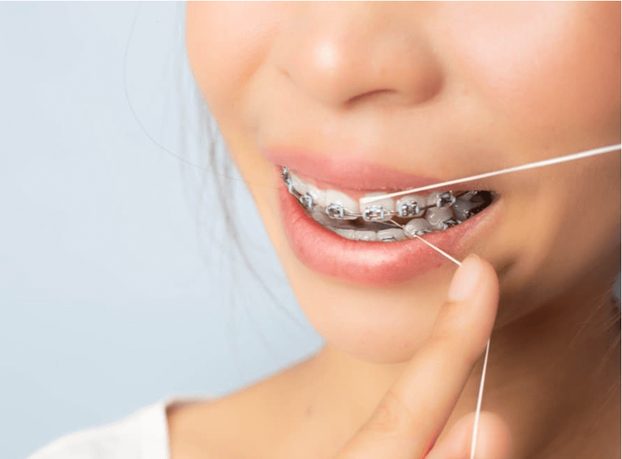 How to dental floss with braces for proper oral hygiene